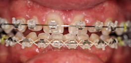Vorher: Patient mit Zahnspange.