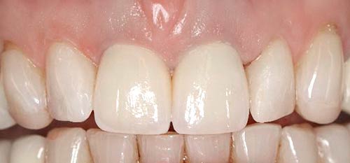 Nachher: Der Einsatz von Vollkeramikkronen sorgt für schöne Zähne.
